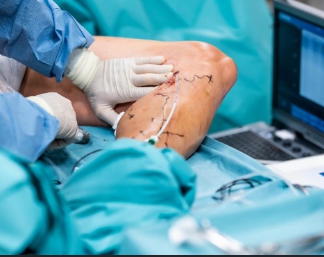 Agosto Azul e Vermelho: cirurgião vascular dá 6 dicas para prevenir varizes, trombose e aneurismas